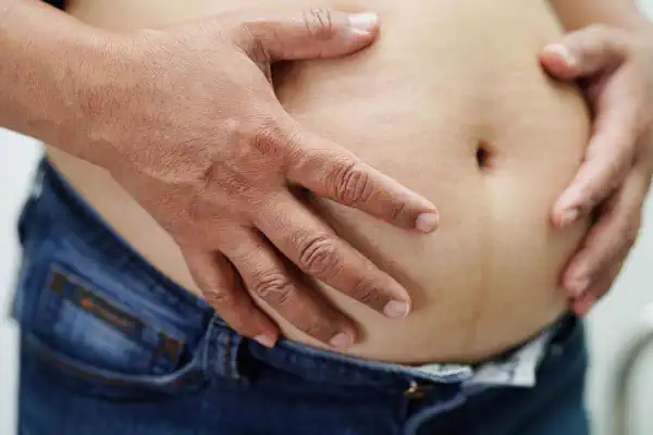 Who is a Good Candidate for Gastric Bypass?